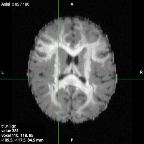 The axial view with the crosshair and its readout