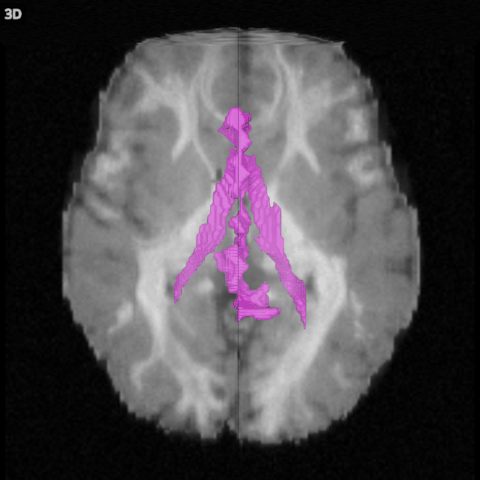 The 3D view: the T1's slices, its dimmed volume rendering and the surface of a mask of the lateral ventricles, seen from above