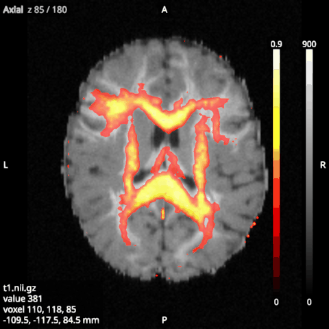 An FA map over the T1, with the hot colormap, a threshold of 0.3 and colour bars