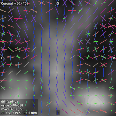 The FOD's peaks over the FA, in the same coronal slice as the FOD glyphs, with Length by amplitude off