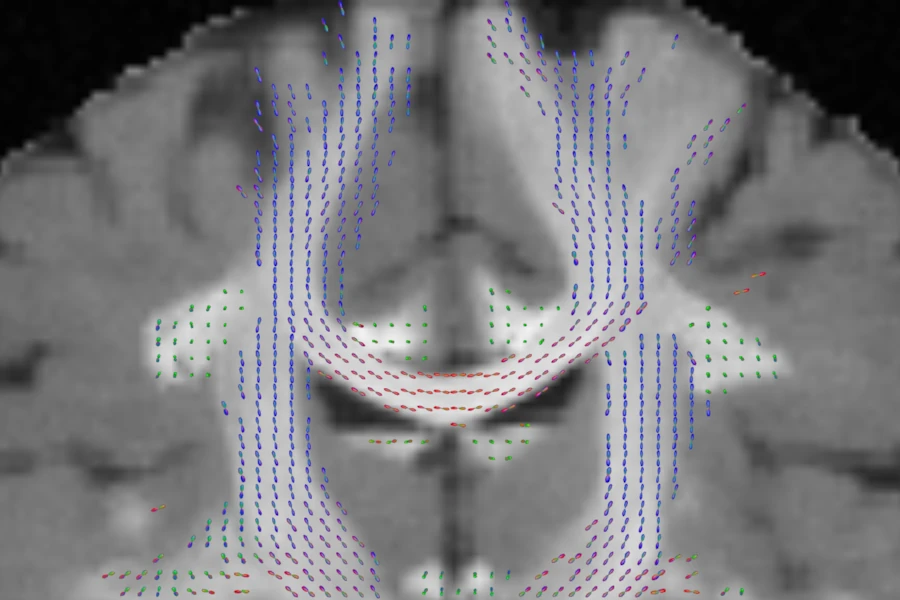 FOD glyphs on a coronal slice of the simulated brain over the T1-like image: the corpus callosum arching left to right in red, the corticospinal tracts running up and down in blue