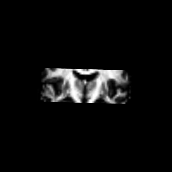 White matter fraction from MSMT-CSD on a coronal slice of the CFIN brain, bright in the white matter
