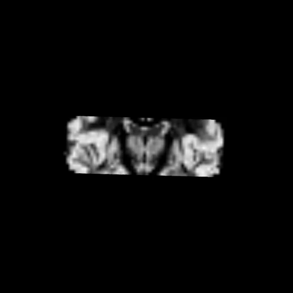 Grey matter fraction from MSMT-CSD on the same coronal slice, bright in the cortex and deep grey matter