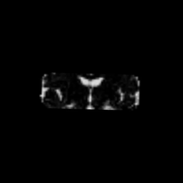 CSF fraction from MSMT-CSD on the same coronal slice, bright in the ventricles and around the brain