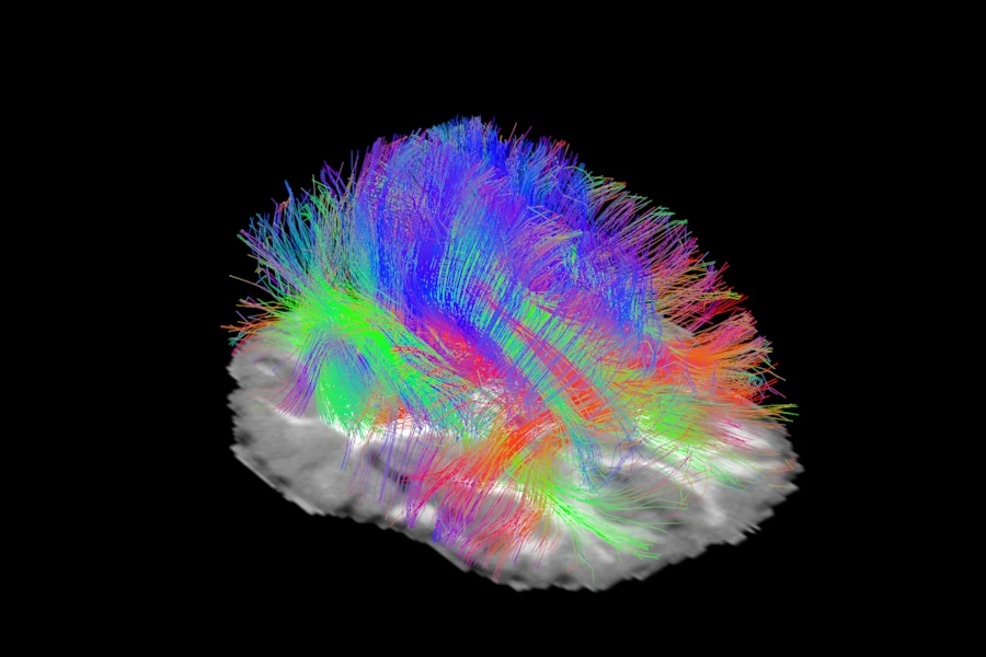 3D view of the simulated brain from above and in front: a tenth of the streamlines of 60 mm or more as thin lines, over an axial slice of the T1-like image