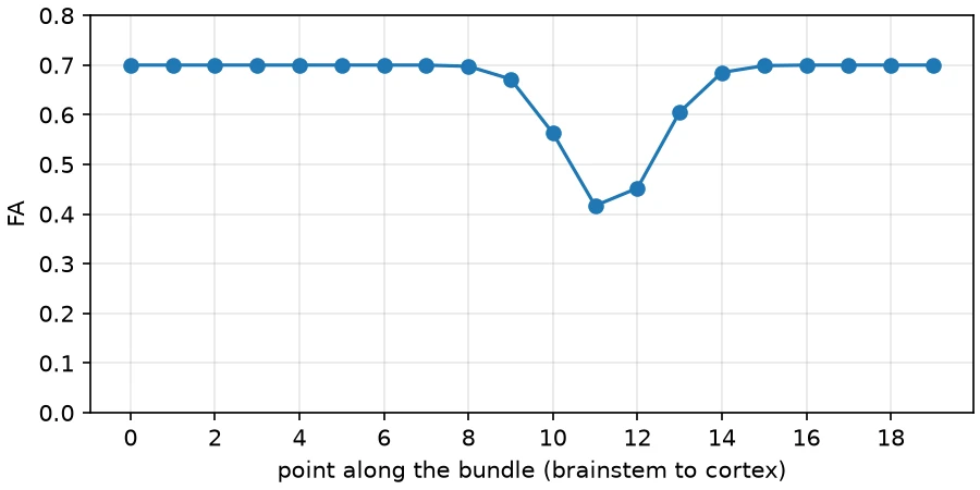 Line plot of FA against the point along the bundle: flat at 0.7, dipping to about 0.4 in the middle at the lesion