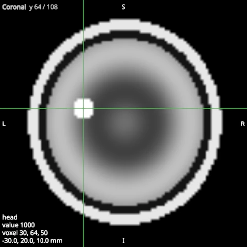 Coronal view of the same head with the crosshair