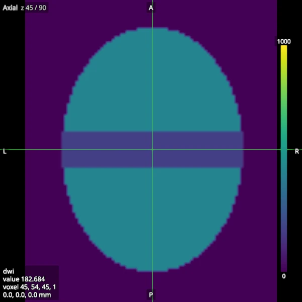 A later volume of the same series, with a gradient along the bundle, where the bundle's signal is darker
