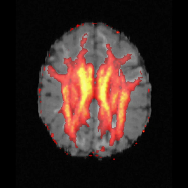 Axial slice of the simulated T1-like image with the FA map over it in a hot colormap, transparent below 0.2