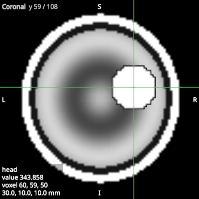 Coronal view of the same head, saved on its own