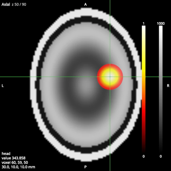 Axial slice of a synthetic head with a blob overlaid in a hot colormap above a threshold, with colour bars, the crosshair and its readout