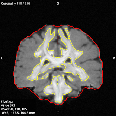 White (yellow) and pial (red) surfaces of both hemispheres, here made from masks of the T1, cut by a coronal slice of it