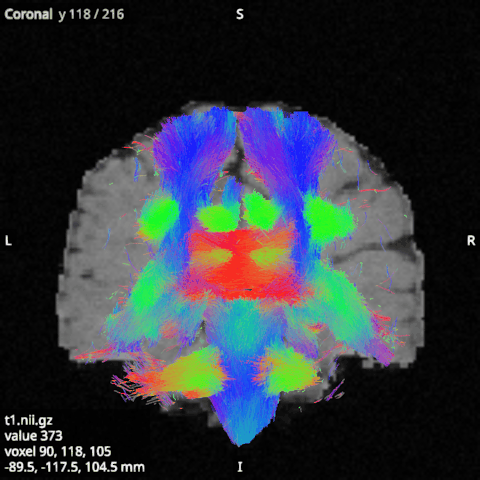 A whole-brain tractogram of 100,000 streamlines over the T1 in the coronal view, with a 10 mm slab