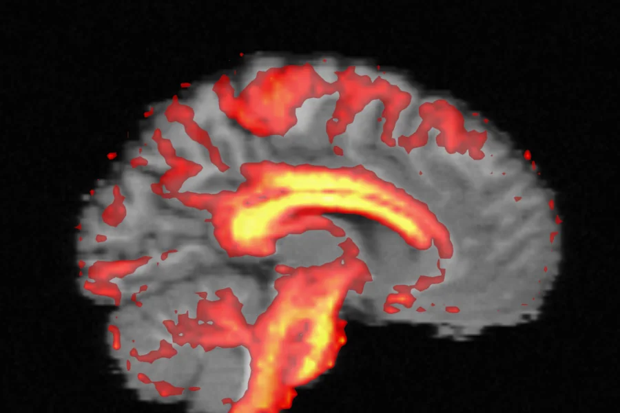 Sagittal slice of the T1-like image with the FA map over it in a hot colormap